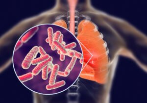Tuberculosis-1-300x210.jpg