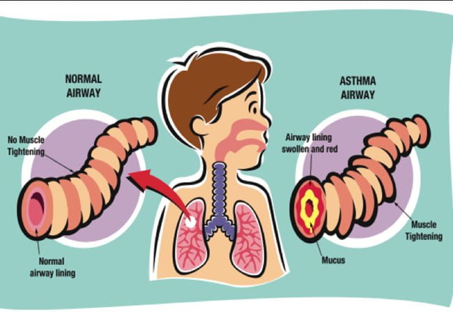 Asthma-1.jpg