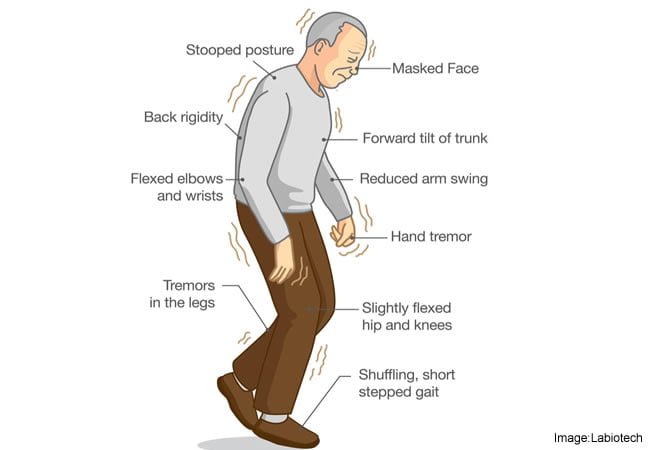 Parkinsons-Disease-Symptoms.jpg