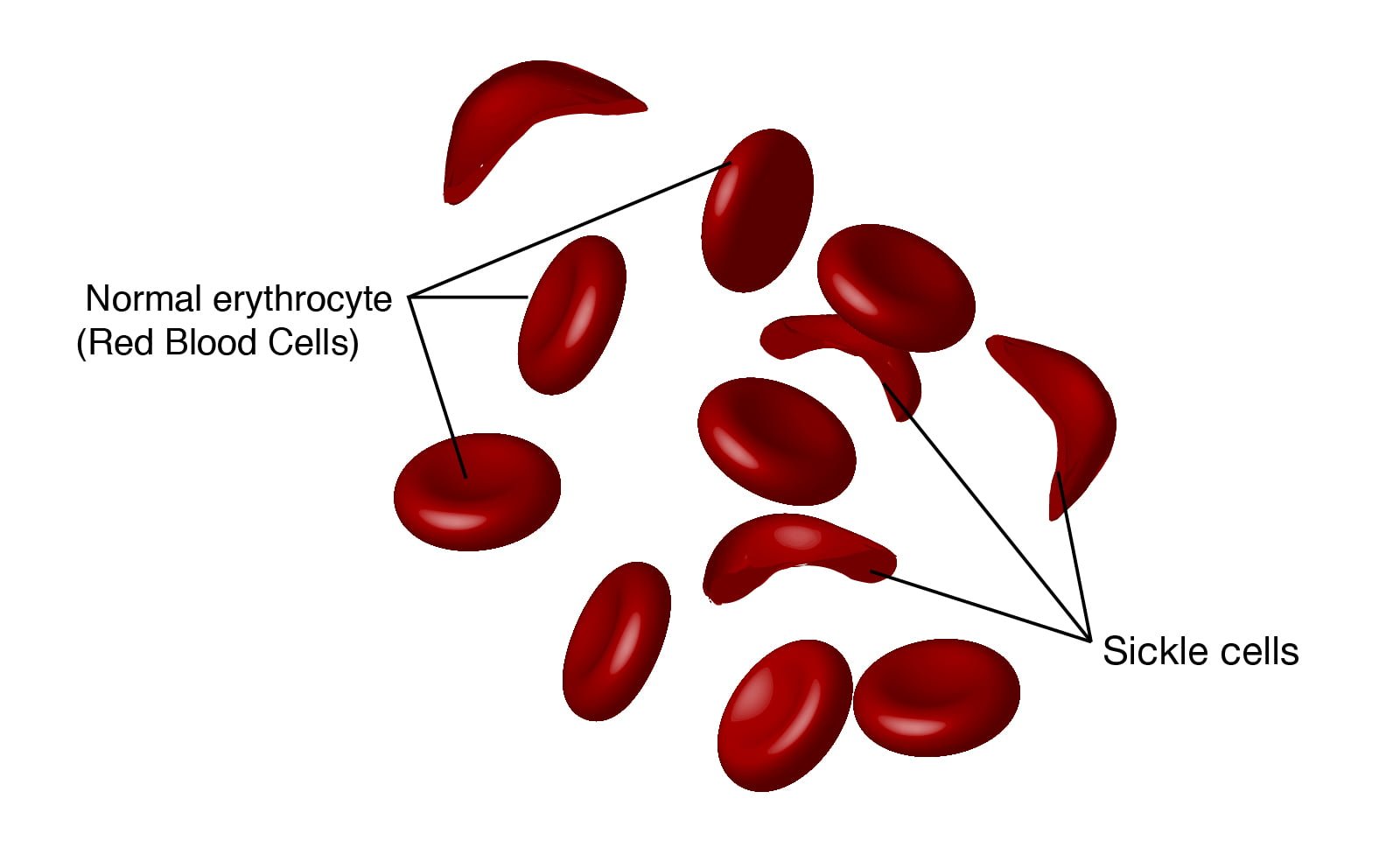 sickle_cell_disease.jpg