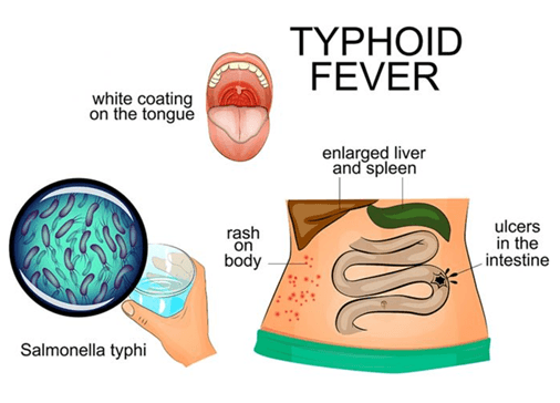 typhoid-fever-Copy.png