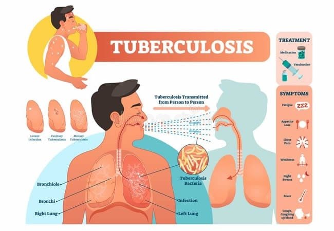 TB-Tuberculosis.jpg