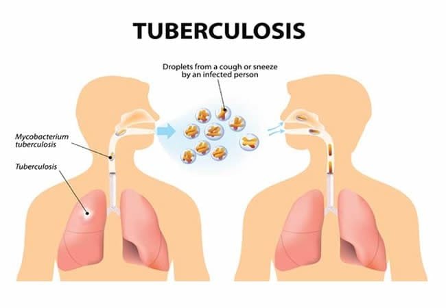 Tuberculosis.jpg