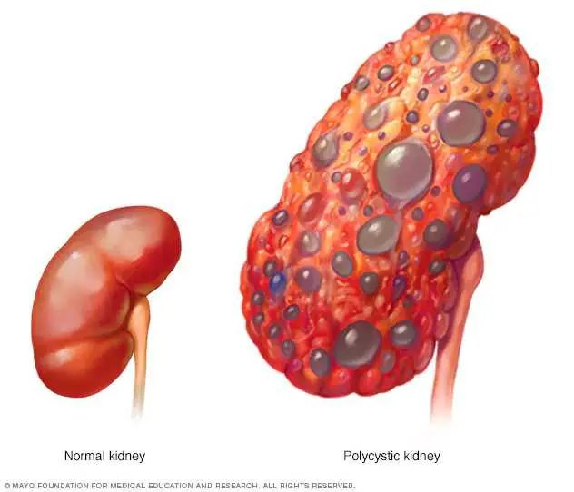 kidney-disease.jpg