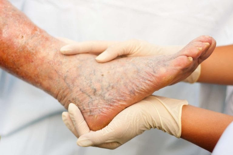 varicose-veins-data.jpg