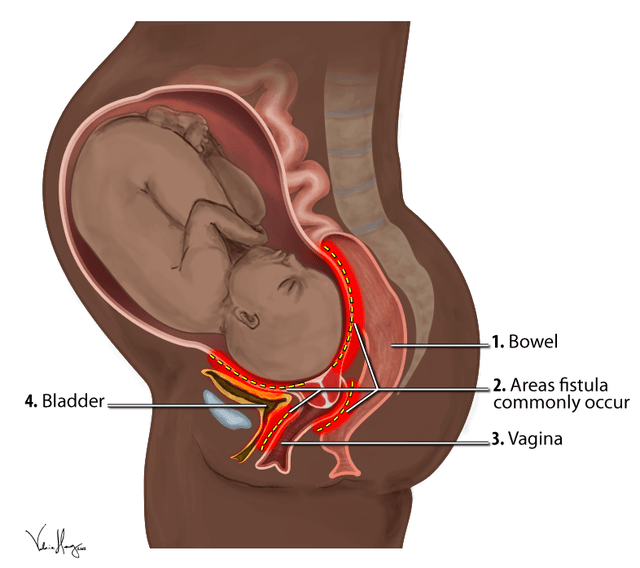 Obstetric_Fistula_Locations_Diagram