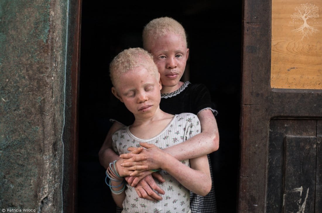 Albinos.jpg