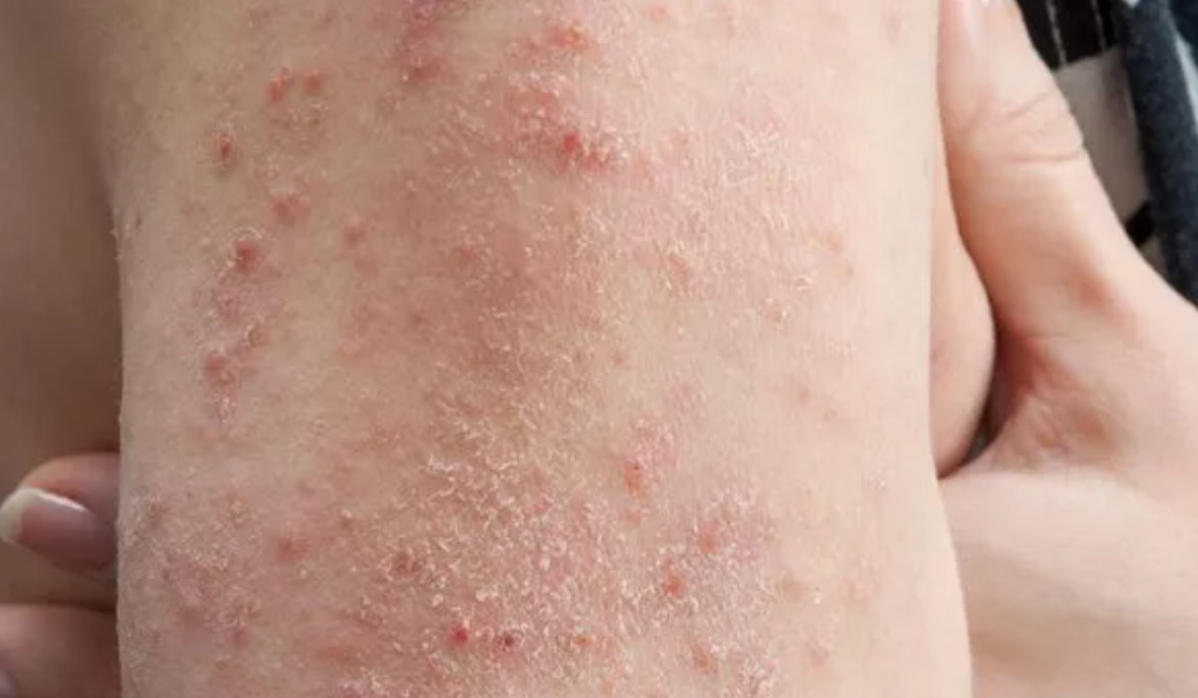 Dengue-fever-symptoms.png