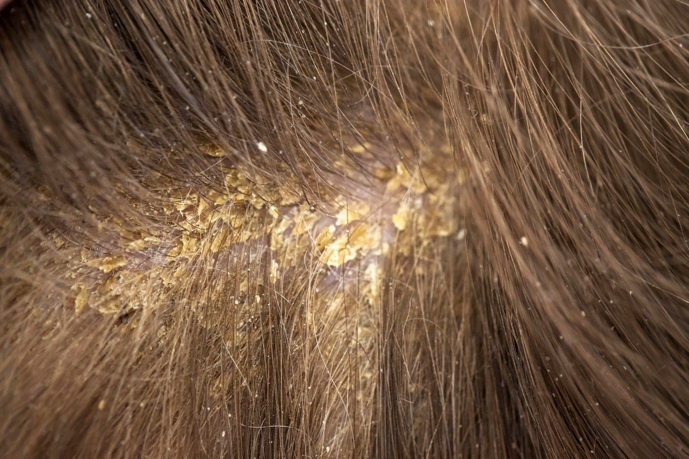 dandruff.jpg
