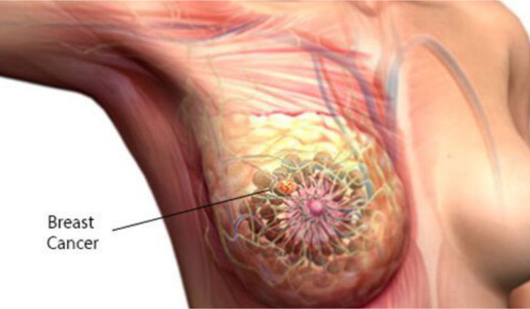 Breast-Cancer.png
