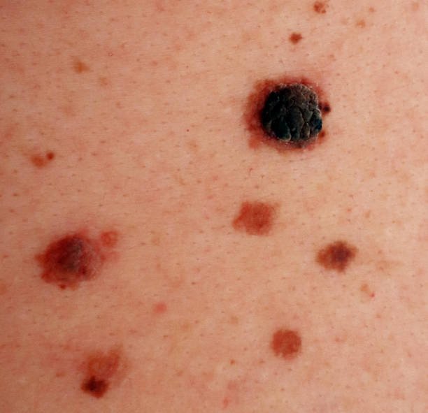 Mole and freckles on the back of a woman. Pigmentation on the back