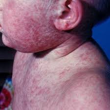 measles1