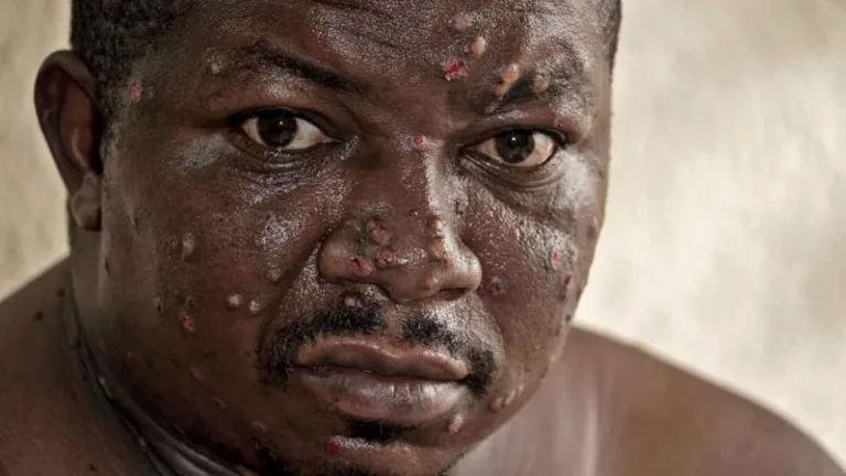 mpox victim