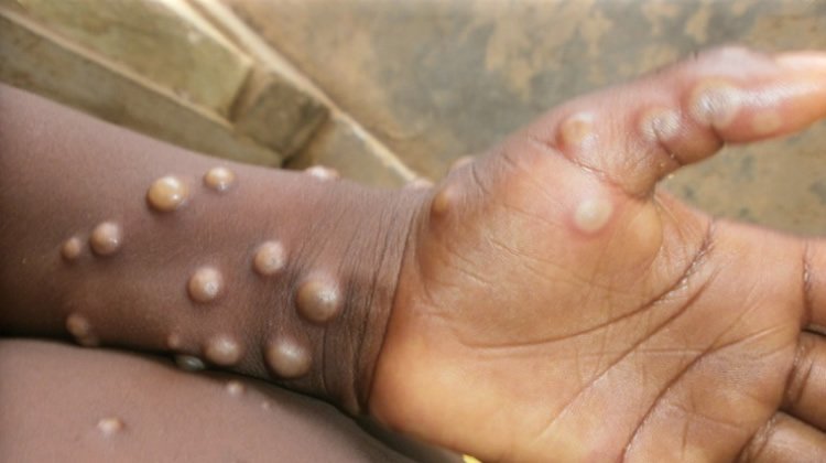 monkeypox case